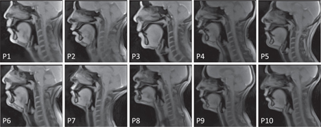 Dynamic images of the vocal tract during speech production