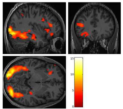 Functional brain MRI