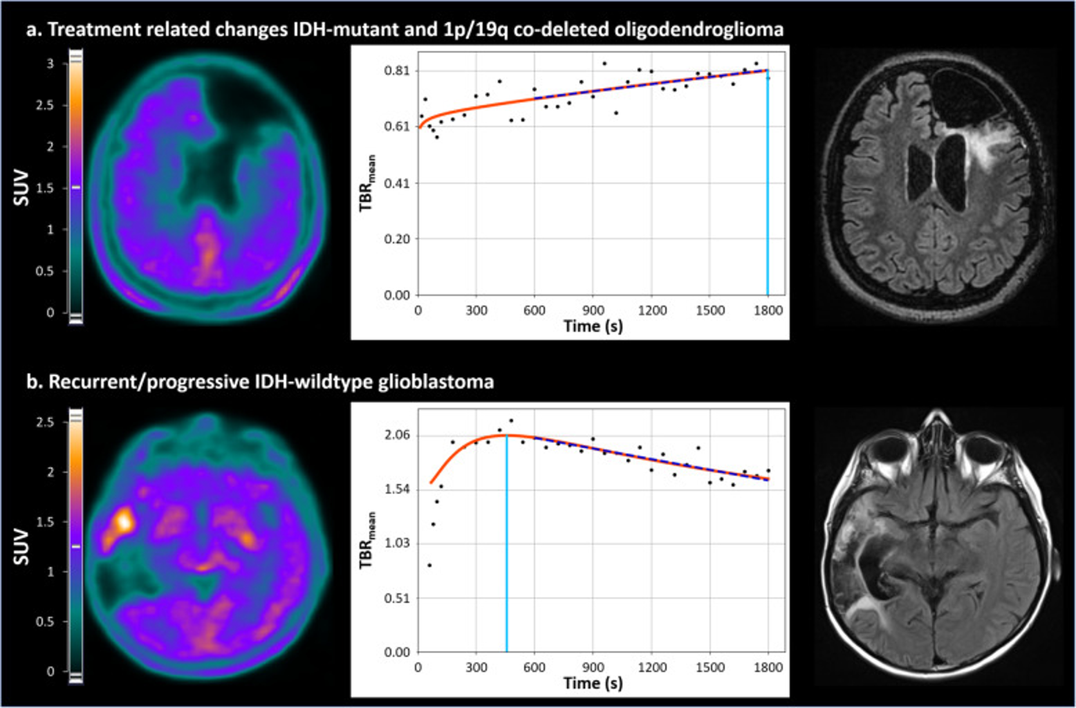 Imagerie TEP au [18F]-DOPA en neuro-oncologie