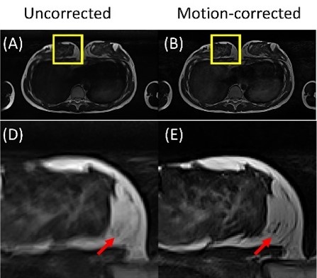Reconstruction corrigée en mouvements non-rigides : exemple en IRM mammaire