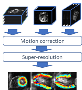 Reconstruction super-résolution de l'orientation des fibres du muscle cardiaque